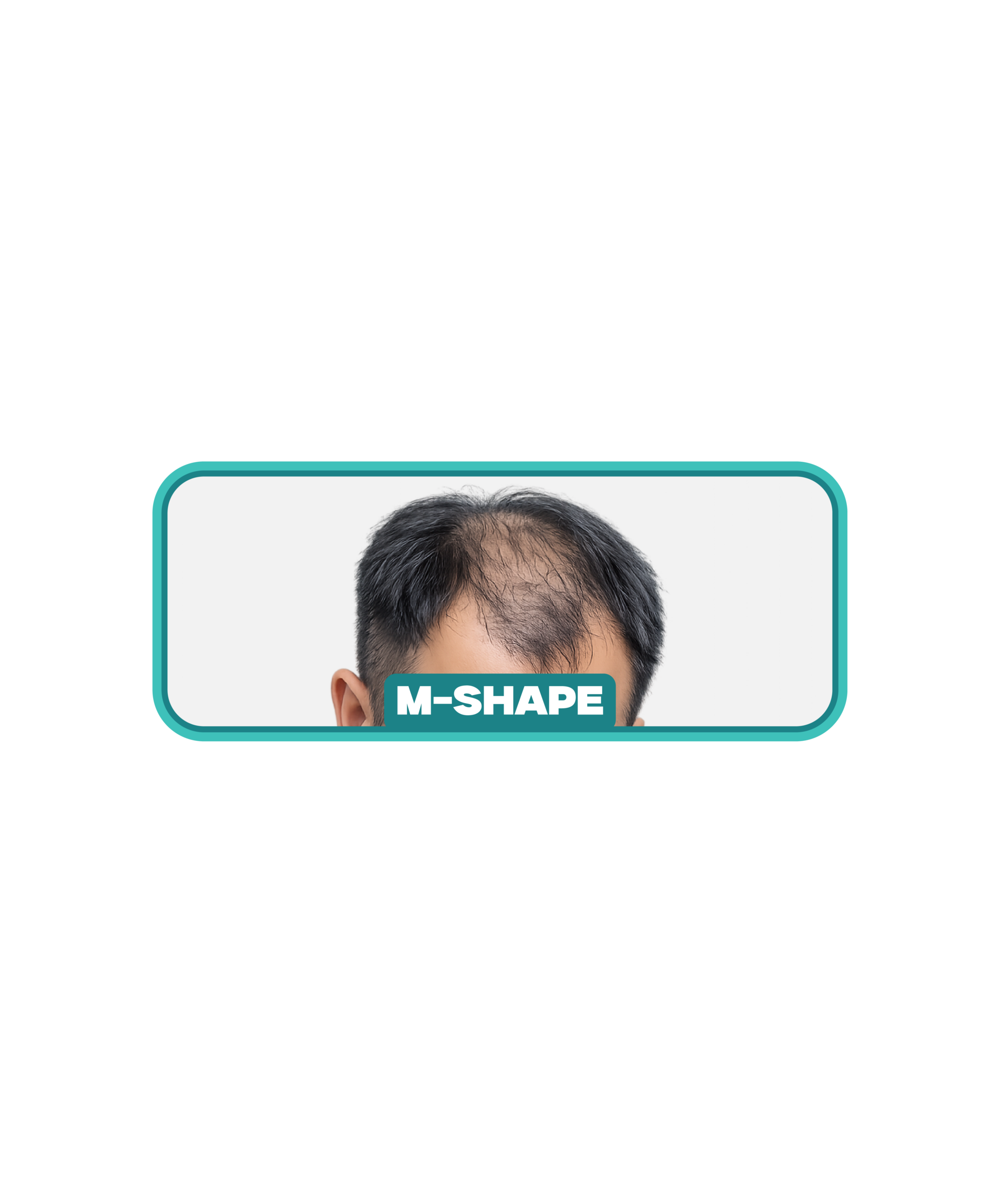 Masalah botak M-Shape
