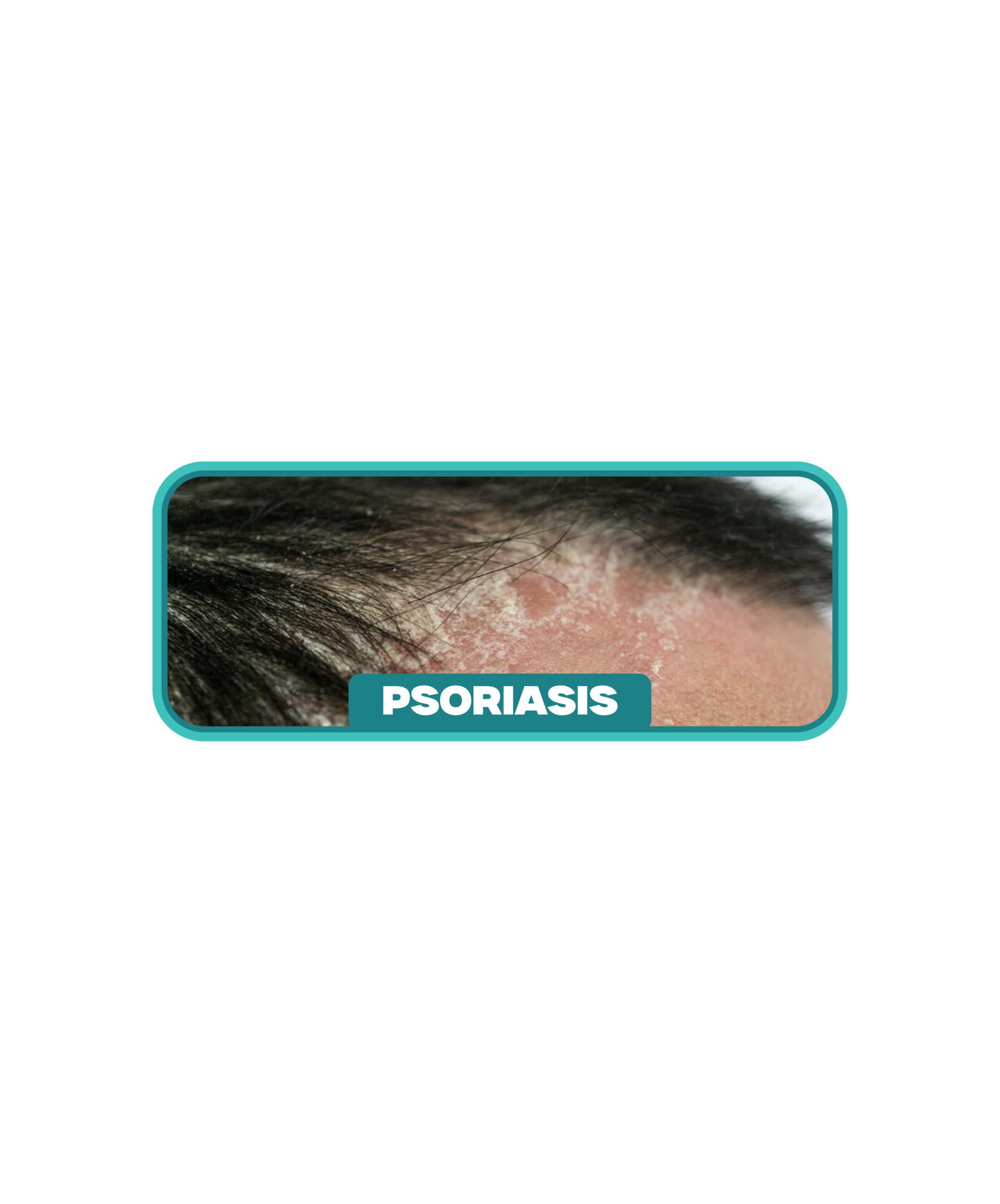 Masalah psoriasis kulit kepala